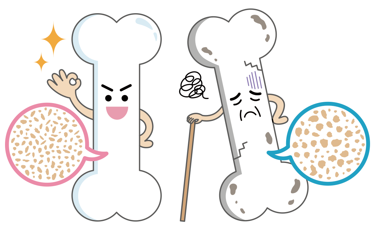 骨粗鬆症（こつそしょうしょう）