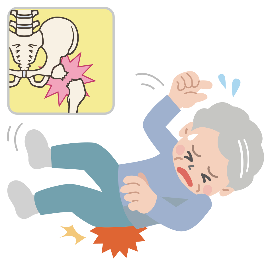 大腿骨頸部骨折（だいたいこつけいぶこっせつ）