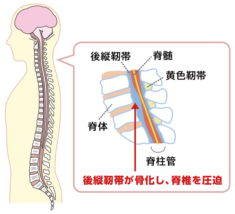 後縦靭帯骨化症（こうじゅうじんたいこっかしょう）