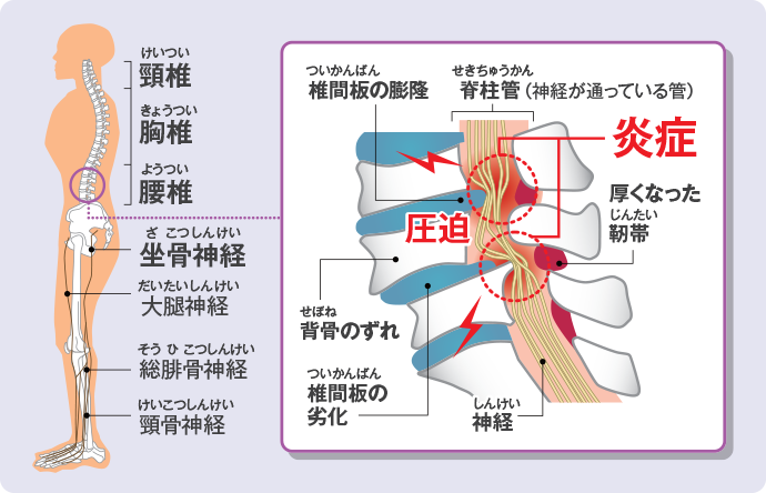 腰部脊柱管狭窄症 (ようぶせきちゅうかんきょうさくしょう)のメカニズム。人型の図：頸椎、胸椎（きょうつい）、腰椎、坐骨神経、大腿神経、総腓骨神経、脛骨神経。脊柱管は背骨や椎間板、関節、靭帯などで囲まれた脊髄の神経が通る細い管（くだ）です。老化で背骨が変形したり、椎間板が膨らんだり、靭帯が厚くなって神経の通る脊柱管が狭くなり（狭窄）、神経が圧迫を受け、神経の血流（けつりゅう）が低下して脊柱管狭窄症が発症します。