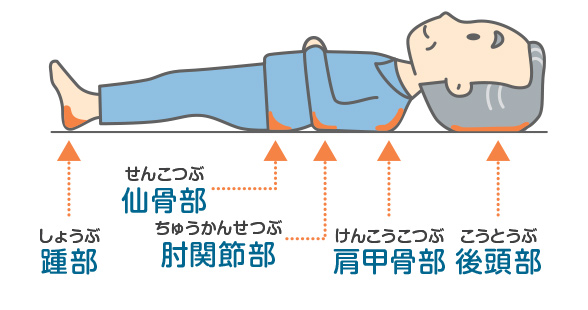 床ずれが起きやすい場所：踵部（しょうぶ）、仙骨部（せんこつぶ）、肘関節部（ちゅうかんせつぶ）、肩甲骨部、後頭部