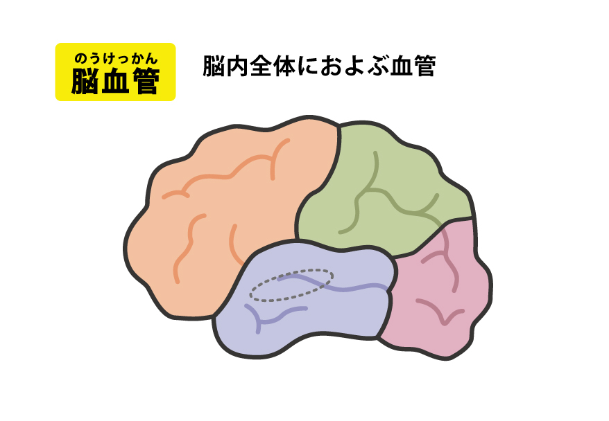 脳血管性認知症　脳血管：脳内全体におよぶ血管