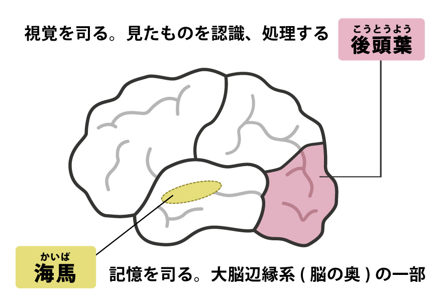 レビー小体型認知症 後頭葉（こうとうよう）：視覚を司る/見たものを認識、処理する 海馬：記憶を司る/大脳辺縁系（脳の奥）の一部